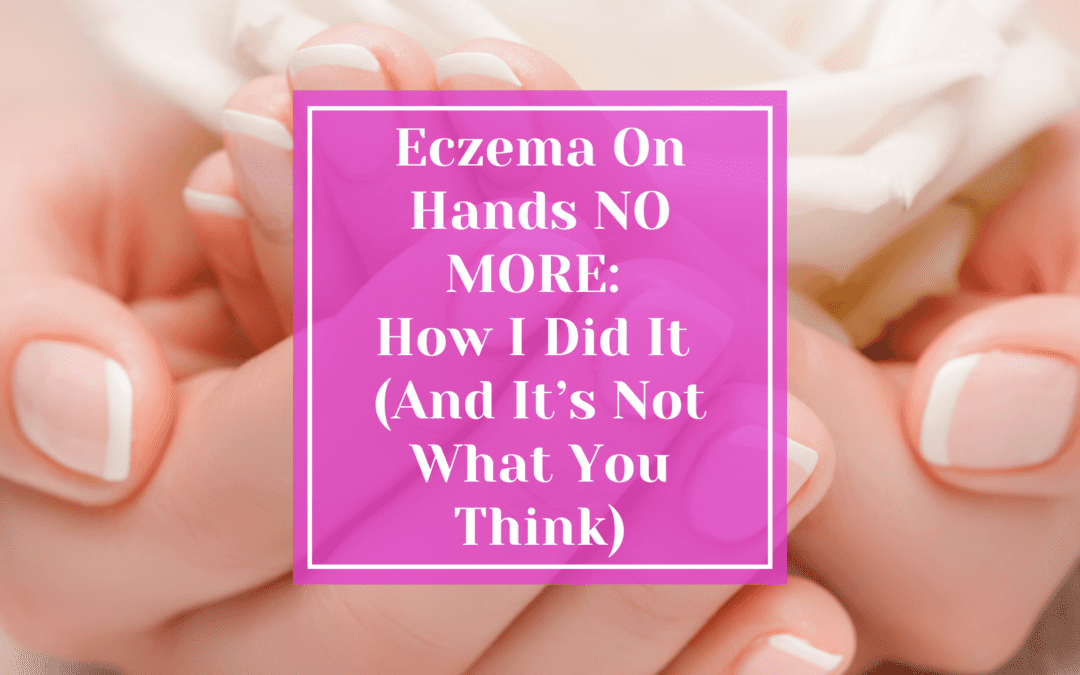 Eczema On Hands NO MORE: How I Did It (And It’s Not What You Think!)