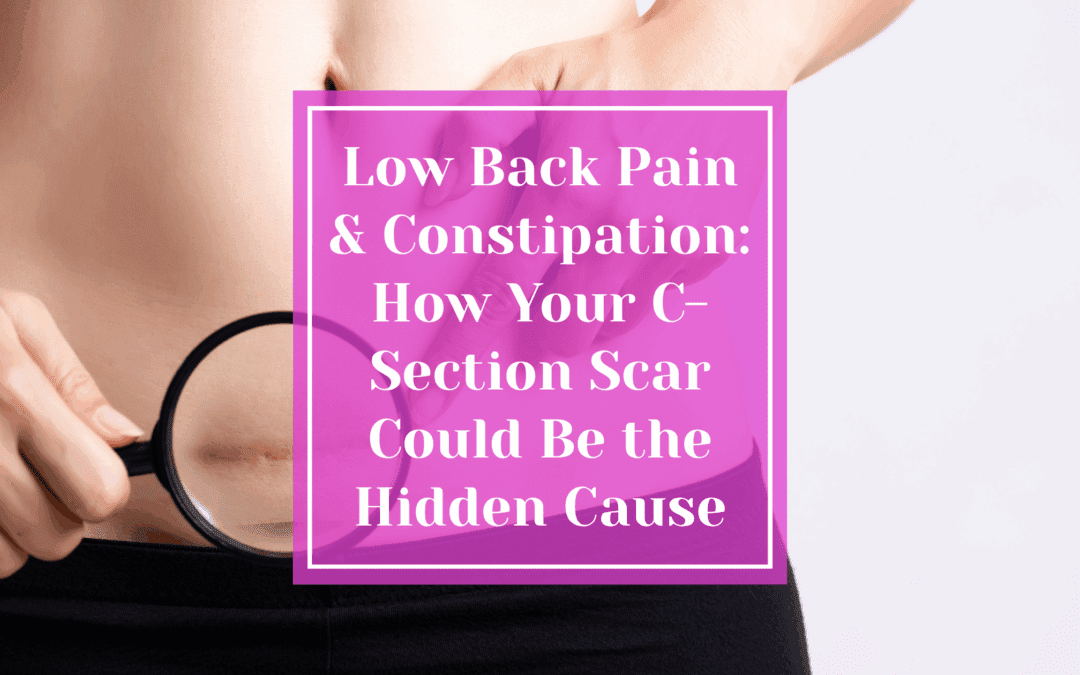 Low Back Pain and Constipation: How Your C-Section Scar Even From Decades Ago Could Be the Hidden Cause